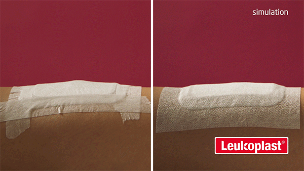 Close-up comparison of surgical tape vs wide area fixation of a swelling dressing over time Close-up comparison of surgical tape vs wide area fixation of a swelling dressing over time
